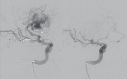 6 Eren S. Resim 8. Sağ hemisferik AVM ve besleyici arterde eşlik eden anevrizma vakası. AVM nin Onyx ile tedavi sonrası görünümü.