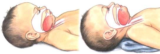 Resim.2.9: Bebeklerde hava yolu açıklığını sağlayan pozisyon Bebeklerde, hava yolu açıklığını sağlamak için omuz ile boynun altına yerleģecek Ģekilde katlanmıģ bir havlu veya bez konulur.