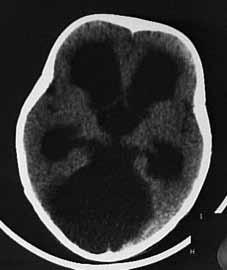 DWM ve diğer nedenlere bağlı hidrosefali ayırt edilebildiği için Bilgisayarlı beyin tomografisi (BBT) DWM da kullanışlı bir tanı metodudur (Şekil 1).