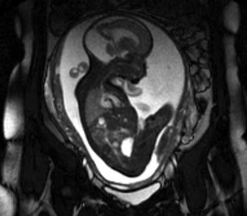 MRG genellikle DWM nun BBT ve ultrasonografi (USG) ile konulan tanısını detaylandırmak için kullanılır. Antenetal dönemde fetal manyetik rezonans görüntülemeden (MRG) den faydalanılabilir (Şekil 2).