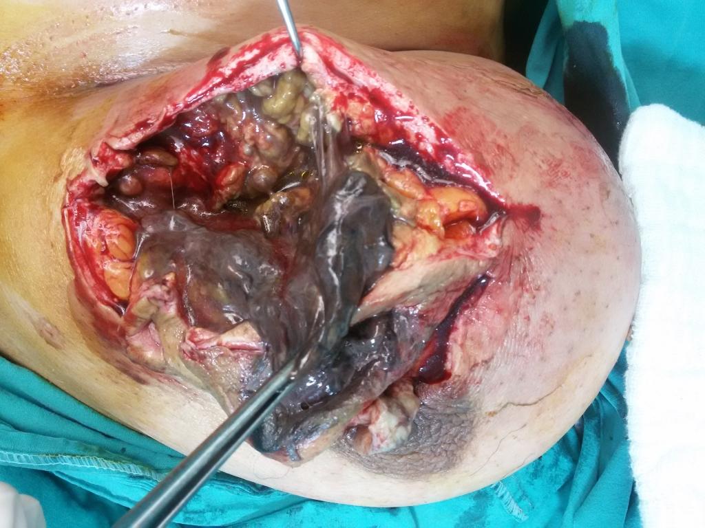 Şekil 2 : Ameliyat sırasında nekrotik dokunun görüntüsü Şekil 3 : Nekrozektomi ve debritman sonrası kalan canlı dokunun görüntüsü Yara % 0.