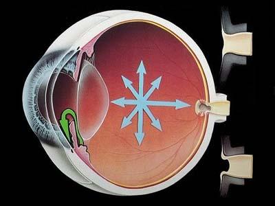 GLOKOM Göz içi basıncının artması (21 mmhg üzeri) sonucu pupilla