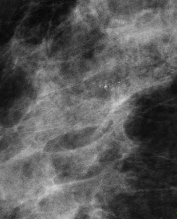 Mamografide lineer dağılım gösteren pleomorfik ve amorf mikrokalsifikasyonlar ve