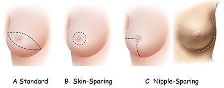 Tanımlar Basit mastektomi Skin-sparing (deri koruyuculu)(konservatif) mastektomi Meme dokusunun tamamı ve meme derisinin büyük bir kısmının
