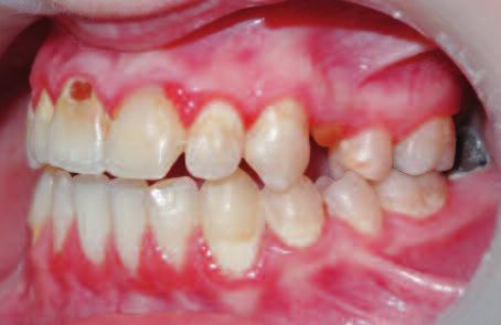 ve endokronlar gibi kalan diş dokusu için daha konservatif tedavi yaklaşımlarını gündeme getirmiştir.