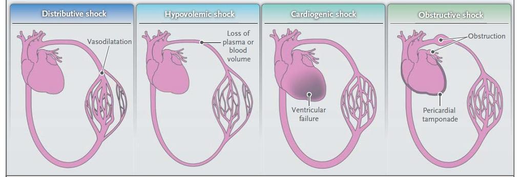 Şok tipleri Hipovolemik Kardiyojenik Distribütif Septik Obstrüktif Sıvı alım azlığı veya sıvı kaybına bağlı olarak intravasküler volümün kaybı sonucu oluşur Miyokardiyal performansın kötü olmasına