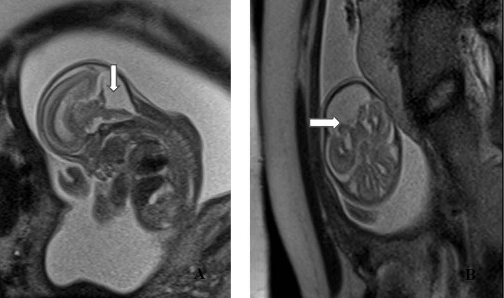 Erifl Yalç n S ve ark. a b fiekil 2. Dandy-Walker malformasyonlu fetüste (a) sagittal ve (b) transaksiyel kesitlerde genifl posterior fossa ve serebellar vermis agenezisi (ok).