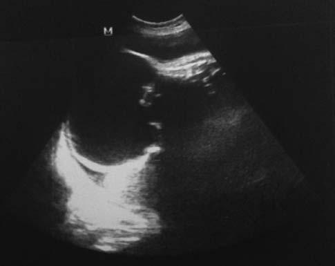 Büyük sakrokoksigeal teratomun prenatal tan s ve takibi muhtemel olan fetüsteki büyük kitle nedeniyle bir baflka sa l k merkezinden hastanemize yönlendirilmiflti.