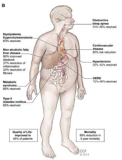 Metabolik Cerrahi Etkileri