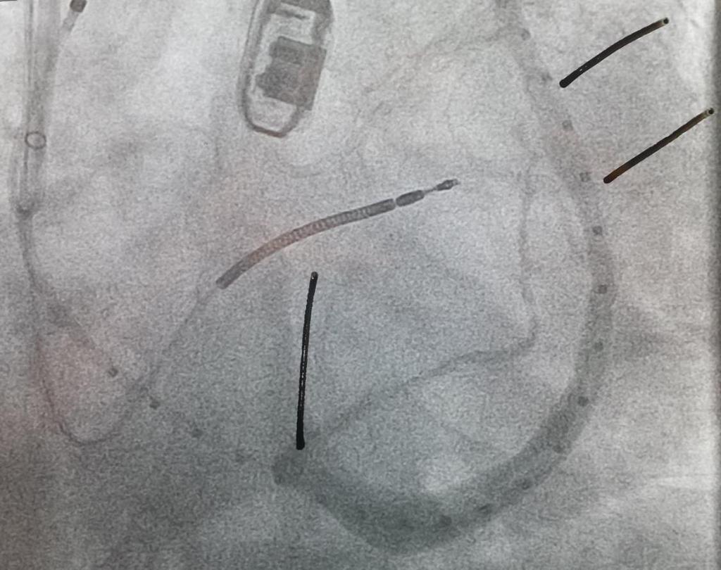 Şekil 3.2: Kanca Yerleşimi için İşaretlenmiş Monitör Ekranı Örneği g. Ven çaplarına ve kullanılabilir ven uzunluğuna dayalı olarak uygun bir implant seçin.