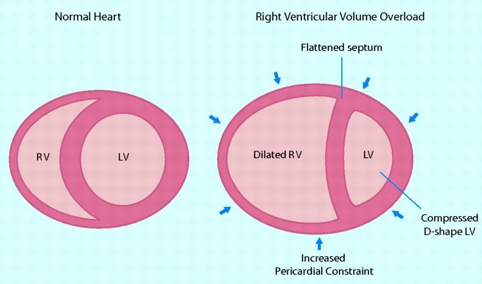 Dikkatli PEEP (invaziv ve non-invaziv ventilasyonda) Kardiyojenik şok, hemodinamik bozukluk!