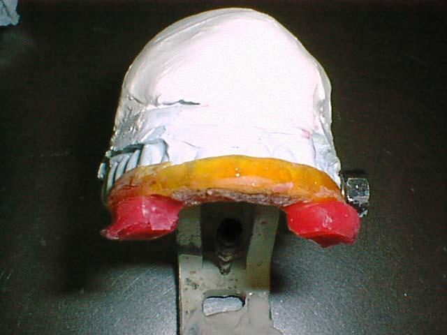 okluzal yüzeyine posterior sınırından anteriora doğru 3-5 mm genişliğinde ve uzunluğunda pembe mum duvarlar yapıştırıldı (Resim 16).