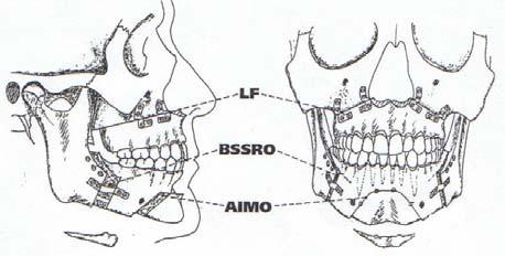 Şekil 16: Anterior mandibuler osteotomi ve dilin pozisyonunu ilerletmek için hyoid kaldıma