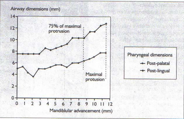 hastada minumum post-palatal ve mandibula ile hem post-palatal hem de post lingual hava post-lingual hava yollarındaki artış (37,38,44) Şekil 26: Mandibuler ilerletmenin farklı derecelerinde hem