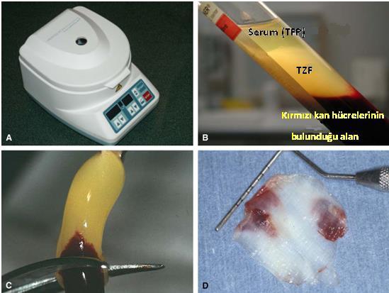 Şekil 2. 5. TZF protokolü (A. Santrifüj işlemi, B. Tabandaki kırmızı kan hücreleri ile tavandaki asellüler plazma arasında kalan fibrin pıhtısı, C. TZF nin toplanması, D.