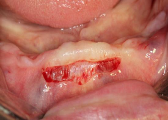 Serbest dişeti greftinin alınması ve alıcı bölgeye yerleştirilmesi Damakta 1. küçük azı dişinin meziali ile 1.