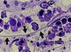 BKVN Tubuler hücrelerin lizisi