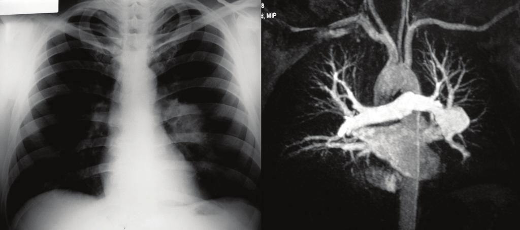 74 Keml Ödev Resim 16. Behçet hstlığın ğlı sol pulmoner rterde nevrizm.. Rdyogrfide sol hiler kitle (ok),. Üç oyutlu kontrstlı MR njiyogrfide sol pulmoner rterde nevrizm (ok).