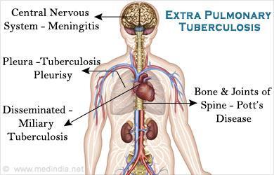 Ekstrapulmoner TB TB herhangi bir organı tutabilir.