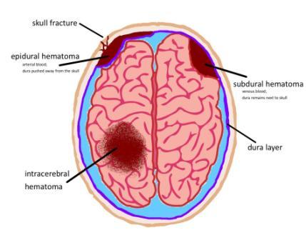 Beyin Kanaması Epidural Hematom: Dura materin dışında, kafatasının altında. Subdural Hematom: Dura materin altında, beynin dışında.
