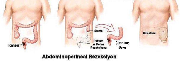 Cholelithotomy (kolelitotomi): Safra kesesinden safra taşını çıkarma ameliyatı Ileostomy (ileostomi): İleumdan vücut dışına ağız açılması.