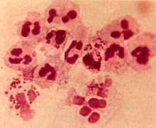 Mikroskopi Semptomatik erkek hastada üretral akıntı örneğinin Gram boyalı incelemesinde hücre içi gram negatif