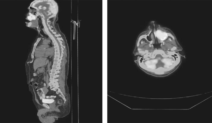 14 KBB ve BBC Dergisi 21 (1):12-6, 2013 Resim 1. Paranasal sinüsden (maksiller sinüs) kaynaklanan kanseri olan hastanın pozitron emisyon tomografi görüntüsü. Resim 2.