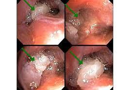 15 Trakeobronşial fungal enfeksiyon şüphesi ile bronkoskopi yapılan 95 hasta