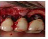 Diş hekimliğinde dezenfeksiyon/sterilizasyon Doku ve kemiğe penatre olan kritik