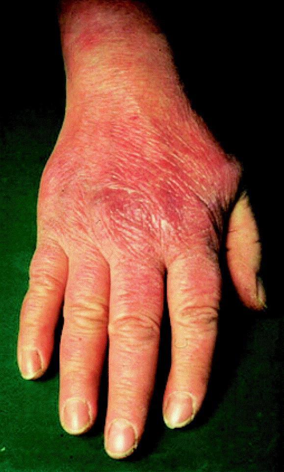 Geç ya da kronik hastalarda dermatolojik bulgular Acrodermatitis chronica atrophicans AKA, primer infeksiyonu takiben yıllar içinde ortaya çıkan bir deri bulgusudur. B.