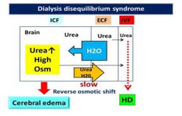 DİYALİZ DENGESİZLİK SENDROMU Genellikle ilk diyaliz seansında gelişir Diyaliz sırasında ya da hemen sonrasında görülür Sistemik ya da nörolojik