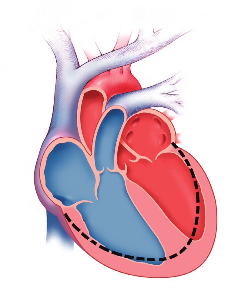 Kalp yetmezliği Kalbin yetersiz kalmaya başlamasının ardında çok çeşitli nedenler yer alabilir. Kalp krizi sonucunda kaslarda oluşan harabiyet bu nedenlerden biri olabilir.
