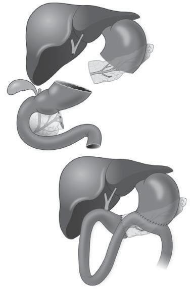 Karaciğer Mide Safra kesesi baş kısmı Çıkartılan kısımlar Duodenum Karaciğer Safra yolları - barsak anastomozu Mide-barsak anastomoz bölümü barsak anastomoz Whipple
