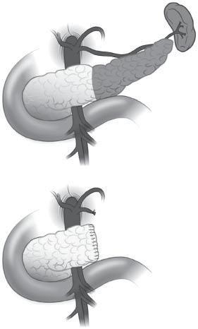 Çıkartılan dalak Çıkartılan (%50) pankreas bölümü Duodenum ın baş ve boyun kısmı Distal pankreatektomi kanserinde cerrahi dışı tedaviler nelerdir?