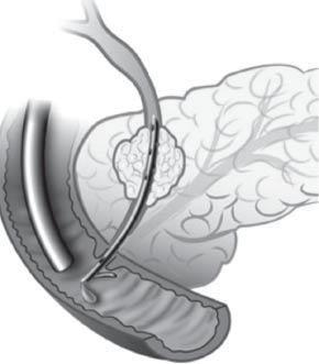 Ortak safra kanalı Endoskop Tümör Stent Duodenum (ince barsağın ilk kısmı) ERCP ile stent yerleştirme Karaciğer Safra