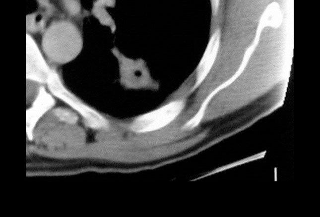 Rigler işareti) - pulmoner