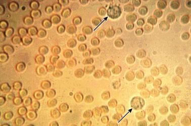 BÖBREK FİZYOPATOLOJİSİ Sistit, prostatit gibi üriner enfeksiyonlarda da geçici hematüri görülebilinir. Persistan hematüri hemen her zaman araştırılmalıdır.