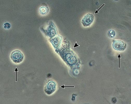 Lenfositlerin ayırt edilmesi içinde sedimentin boyanması gerekmektedir. İdrar mikroskobisinde lenfosit görülmesi renal allograft alıcılarında akut hücresel rejeksiyonu gösterir.