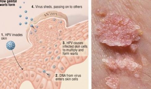 HPV (Human Papilloma virus) İçerik Endikasyon Kontrendik asyon Uyarılar 2vHPV (cervarix), 4vHPV,