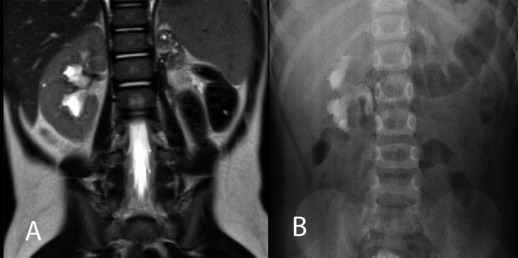 Resim 4. MRÜ de (A) ektopik yerleşimli böbreğin füzyone olduğu izleniyor. İVÜ de (B) sadece sağ böbreğin ektopik olduğu görülebiliyor. Resim 5.