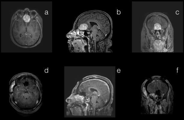 Turan Y., Yılmaz T. Resim 3. Olfaktor oluk menenjiomu olan 48 yaşındaki kadın hastamızın; preoperatif axial (a), sagittal (b) ve coronal (c) kesit kontrastlı kranial MRG görüntüleri.