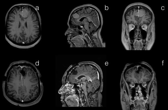 Orta fossada menenjiomu olan 50 yaşındaki kadın hastamızın; preoperatif axial (a), sagittal (b) ve coronal (c) kesit kontrastlı kranial MRG görüntüleri.