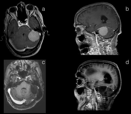 Falks menenjiomu olan 41 yaşındaki kadın hastamızın; preoperatif axial (a), sagittal (b) ve coronal (c) kesit kontrastlı kranial MRG görüntüleri.