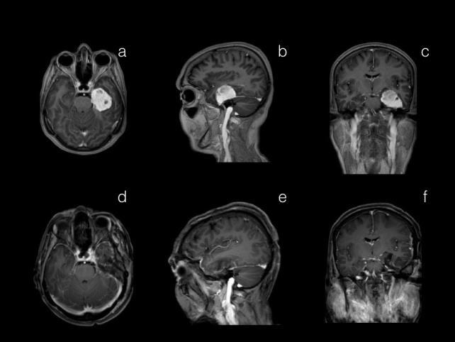 Tentorial yerleşimli menenjiomu olan 72 yaşındaki kadın hastamızın; preoperatif axial (a), sagittal (b) kesit kontrastlı kranial MRG görüntüleri.