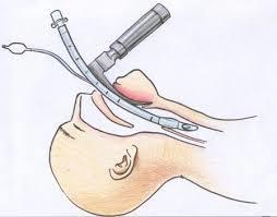 6. Solunum Sistemi Cerrahi Terimleri Endotracheal intubation:
