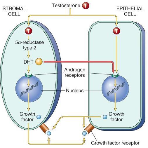 Benign Prostat Hiperplazisi / Nodüler Hiperplazi Etyoloji-patogenez: Dihydrotestosteron (DHT) Stromal ve epitelyal prostat hücrelerinde nüklear