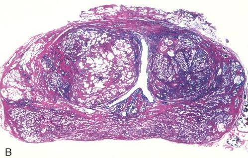 Benign Prostat