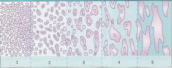 Grade 1: Tümör, tek sıralı prizmatik epitel hücreleriyle döşeli basit glandüler yapıların monoton şekilde birbirine yakın olarak yerleşmesinden oluşur.