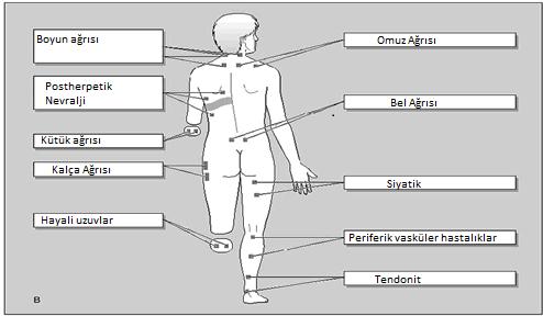 1 Vücudun Ön Kısmı; Şekil 6 TENS cihazının vücudun ön kısmında uygulanılacak