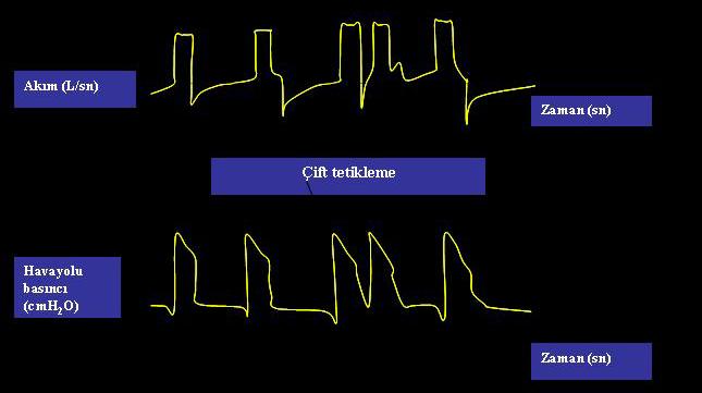 Ekspiryum Asenkronisi İnspiryumda erken sonlanma Ventilatör inspiryumu hasta inspiryumundan önce